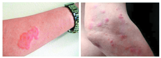 Skin rashes and itchiness accompany bedbug bites. [KOREA DISEASE CONTROL AND PREVENTION AGENCY] 