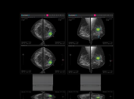 Lunit Insight DBT, Korean medical startup Lunit's latest AI-powered medical software that gained approval from the U.S. Food and Drug Administration [LUNIT]