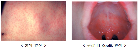 Measles rash cases [JOONGANG ILBO]