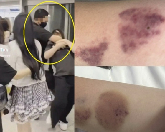 A bodyguard for girl group Hearts2Hearts is shown restraining a fan at Incheon International Airport, left, and a female fan posted pictures of bruises on her arms claiming that they were from a bodyguard for the group. [SCREEN CAPTURES]