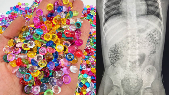 Water beads, left, and an X-ray image of the 10-month-old infant in the United States who died after swallowing them [CONSUMER PRODUCT SAFETY COMMISSION] 