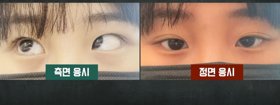 A woman who received under eye fat removal surgery at a clinic in Daegu in February said she suffered from double vision and eye misalignment in an appearance on JTBC's "Crime Chief" (2014-) on Aug. 4. [SCREEN CAPTURE]