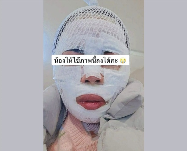 A Thai woman suffers burns to her face after her Korean partner allegedly poured boiling water on her, according to a photo captured from Facebook. [SCREEN CAPTURE]